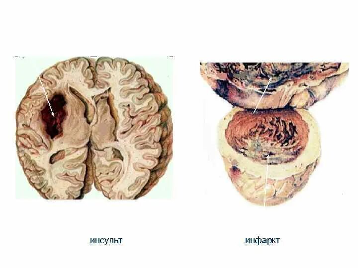 Инсульт различия. Инсульт и инфаркт. Различие инфаркта и инсульта. Инфаркт и инсульт разница. Инфаркт от инсульта.