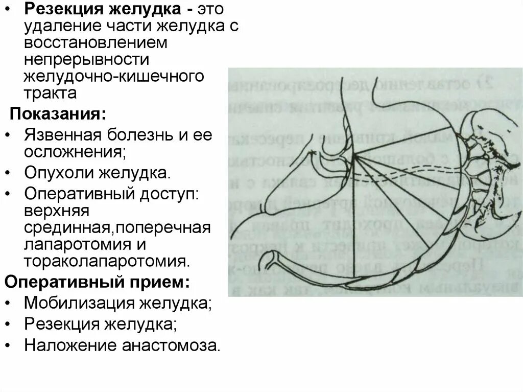 Резекция желудка Оперативная хирургия. Резекция желудка радикальная операция. Продольная резекция желудка (ПРЖ). Операция удаления опухоли желудка