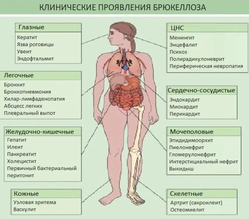 Инфекции бруцеллез. Бруцеллез клинические проявления. основные клинические симптомы бруцеллёзе. основные клинические проявления бруцеллеза. бруцеллез симптомы у человека.