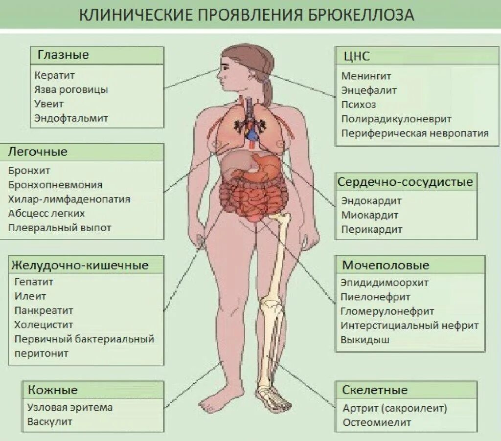 Бруцеллез клинические проявления. Основные клинические симптомы бруцеллёзе. Основные клинические проявления бруцеллеза. Бруцеллез симптомы у человека. Что за болезнь бруцеллез у человека симптомы