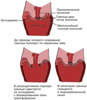 Зона трансформации шейки