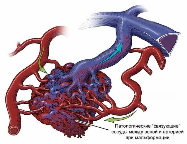 Сосудистая аномалия. Артериовенозная мальформация сосудов. АВМ мальформация сосудов головного мозга. Артериовенозные мальформации сосудов головного мозга. Артериовенозная мальформация (АВМ).