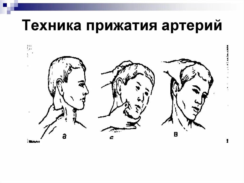 Кровотечение височной артерии. Кровотечение височной артерии