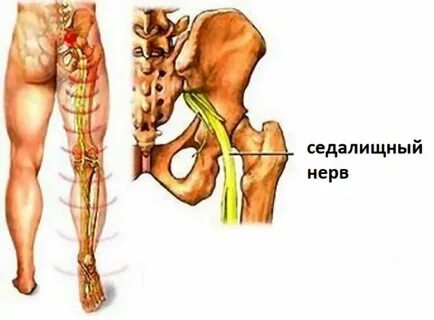 Люмбоишиалгия мкб 10 у взрослых