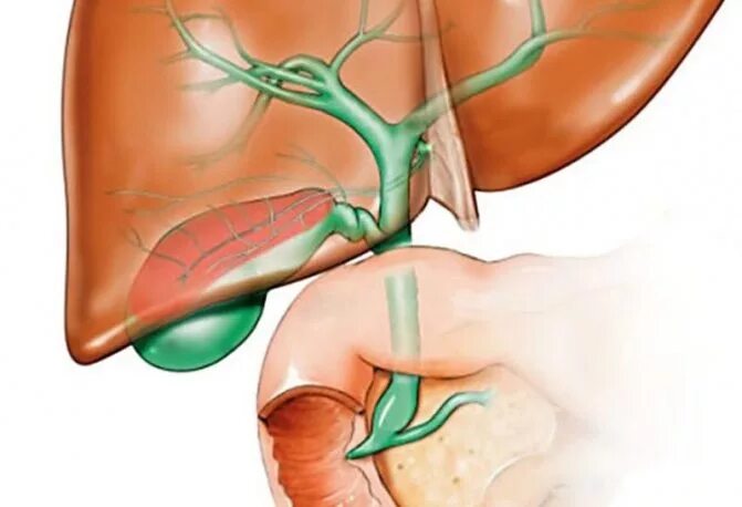 Билиарная гипертензия это. Гипертензия желчного пузыря. Билиарная гипертензия. Внепеченочная билиарная гипертензия.