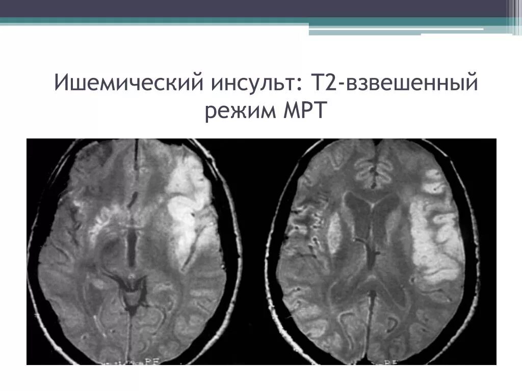 Геморрагический инсульт мрт т1. Мрт ишемический инсульт т1. Ишемия головного мозга мрт т2. Ишемический инсульт кт. Ишемические изменения головного мозга