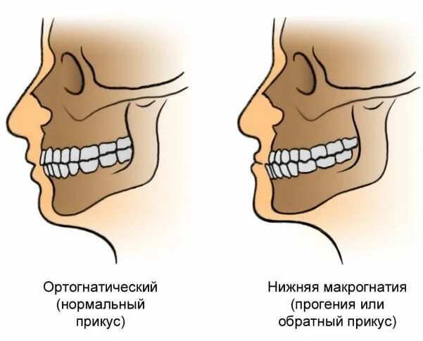 Микрогнатия это