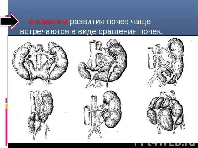 Аномалии развития нерва. Аномалии развития почек. Врожденные аномалии почек. Аномалии структуры почек. Аномалии развития почек и мочевыводящих путей.