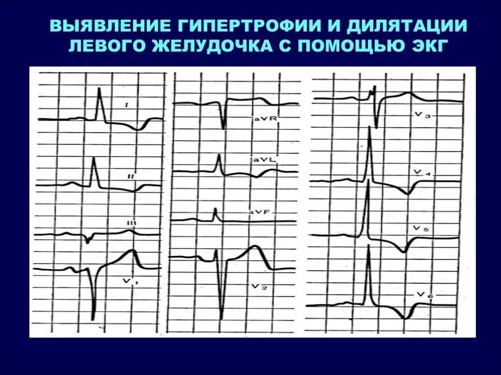 Гипертрофия левого желудочка на ЭКГ. Гипертрофия желудочков на ЭКГ. Гипертрофия миокарда левого желудочка на ЭКГ. ЭКГ при гипертрофии левого желудочка. Перегрузка на экг что это