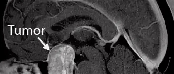 Опухоль мозга у собак. Пресакральная киста мрт. Киста промежуточного паруса. Киста промежуточного паруса кт.