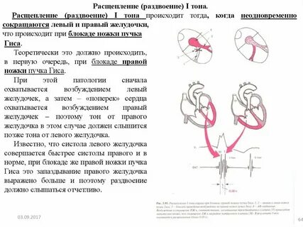 Блокада правого желудочка