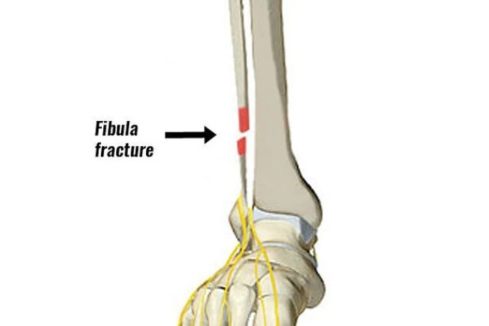 The fracture can be. The fracture can be