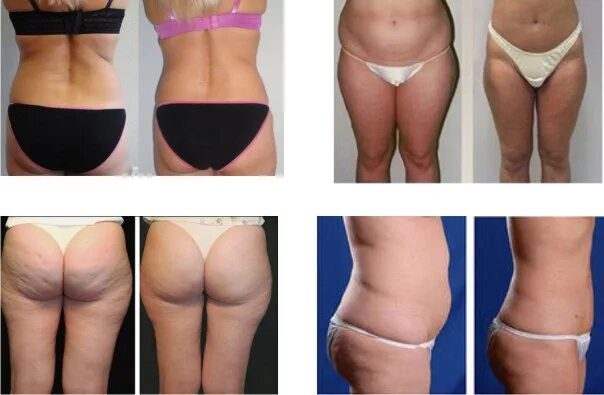 Lpg тела отзывы. Антицеллюлитный массаж lpg. Эффект от lpg массажа до после. Lpg массаж тела до и после. Кавитация старвак.