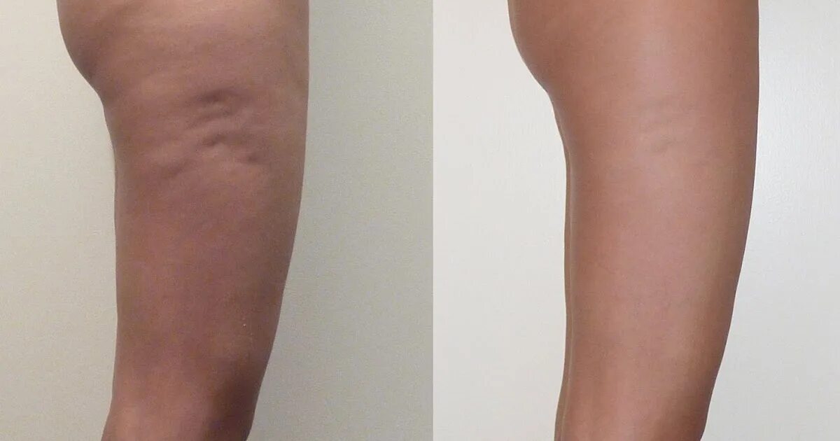 Лимфодренажный массаж до и после. Карбокситерапия от целлюлита. Кавитация ноги до и после. Липосакция от целлюлита.
