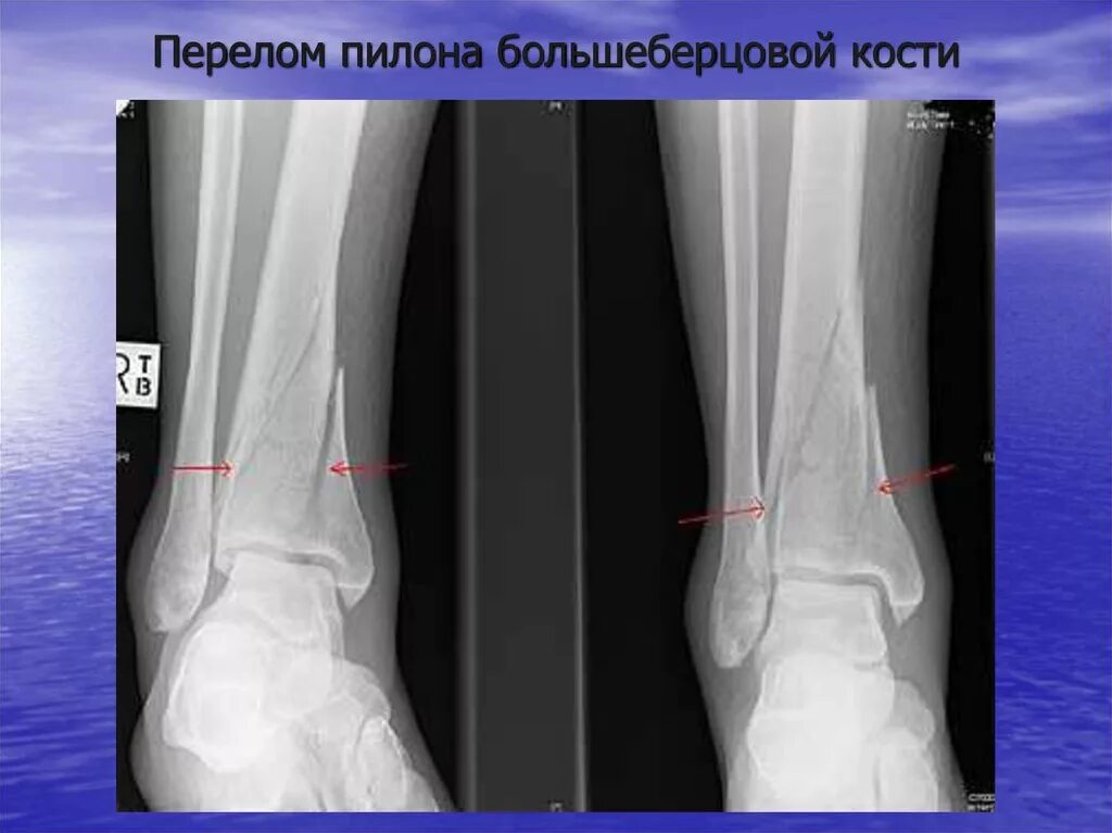 Перелом метаэпифиза малоберцовой кости. Субкапитальный перелом малоберцовой кости. Перелом пилона большеберцовой кости. Краевой перелом большеберцовой кости голени. Перелом н 3