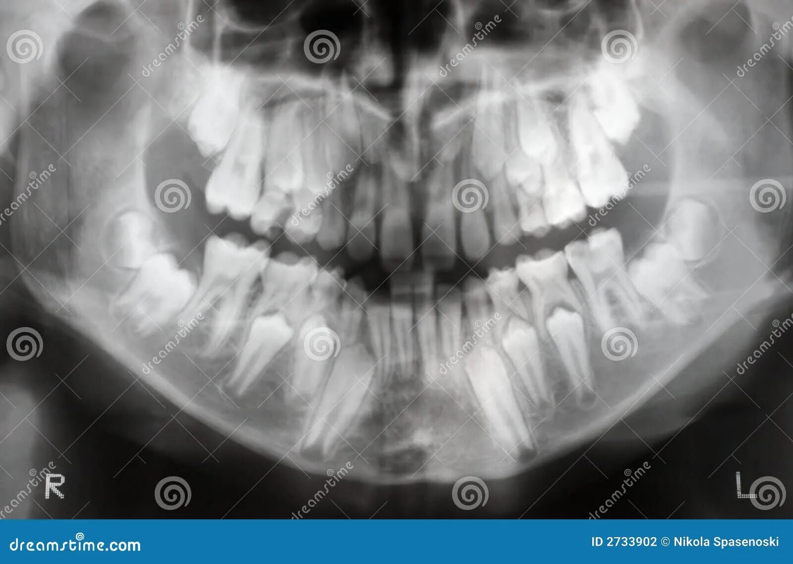 Экзостоз кости челюсти. Смена молочных зубов у детей рентген. Экзостоз верхней челюсти рентген. Снимок черепа ребенка с зубами. Детский череп рентген