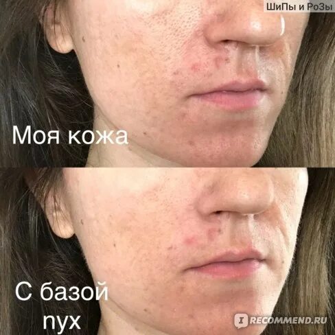 Тональный для проблемной кожи с акне. Тональный крем для проблемной кожи с акне. тоналка для проблемной кожи и жирной кожи с акне. тональный крем для проблемной кожи с акне бюджетный.
