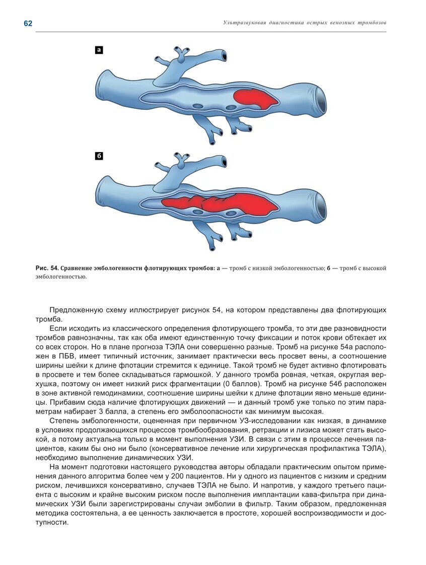 Признаки флотации тромба на УЗИ. Флотирующий тромб признаки. Критерии флотирующего венозного тромба. Флотирующий тромб диагноз. Тромбоз без флотации