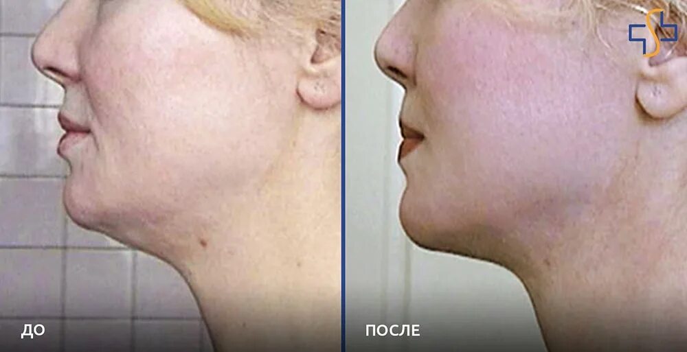 нити для подтяжки шеи и подбородка. нити аптос в подбородок до и после. подтяжка второго подбородка нитями.