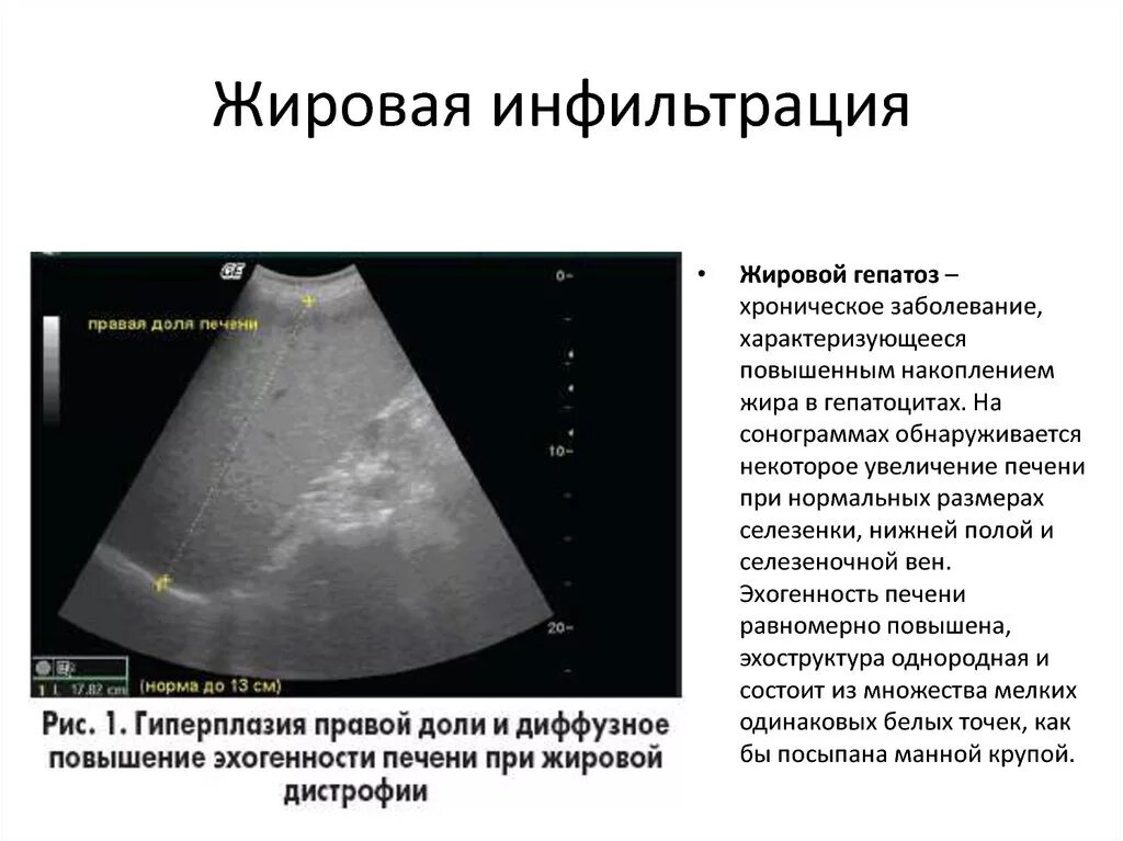 Как лечить жировую инфильтрацию