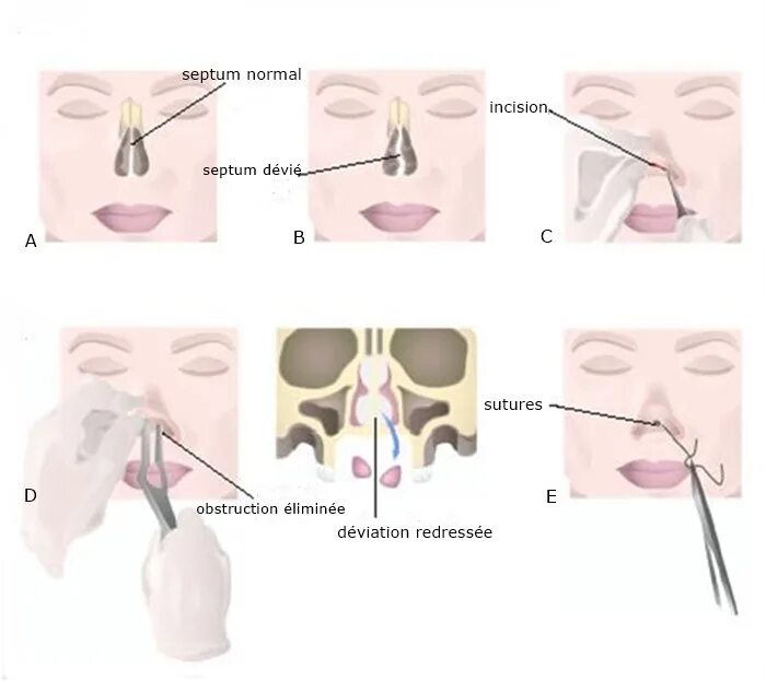 Турунды септопластика. Септопластика носовой перегородки операция. Подслизистая резекция перегородки носа. Пластины для операции септопластика. Какие операции делают на носу
