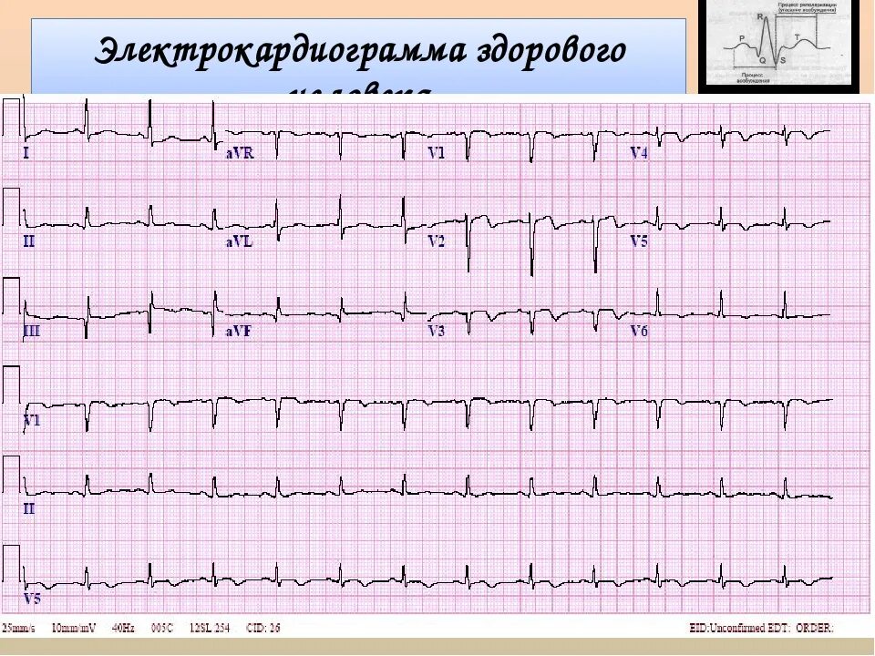 Кардиограмма ЭКГ здорового человека. Как выглядит ЭКГ здорового человека. ЭКГ 3 отведение норма. ЭКГ кардиограмма норма нормальная. Экг сочи