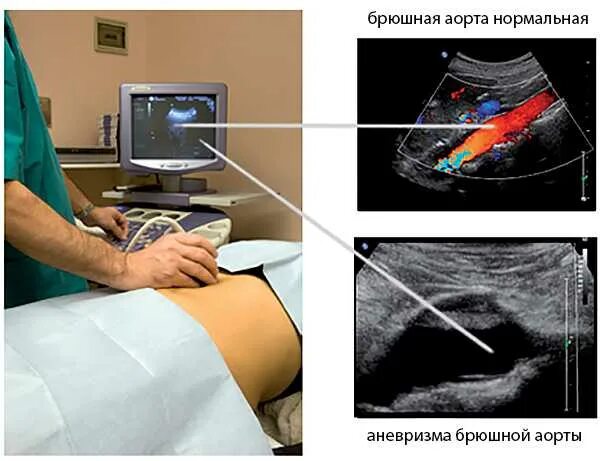 Доплер конечностей. Ультразвуковая допплерография артерий нижних конечностей. Ультразвуковая допплерография аорты. Ультразвуковая допплерография аорты брюшной. Допплерография сосудов аорты.