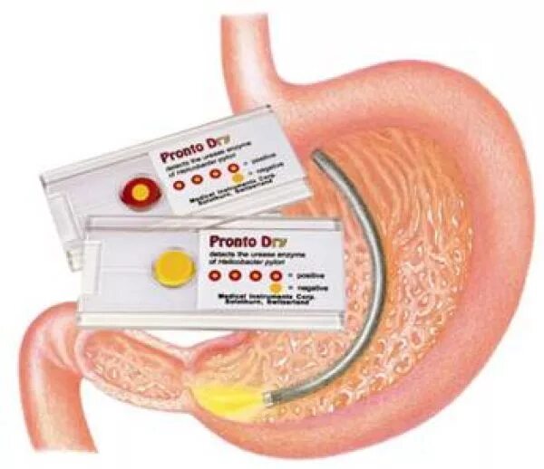 Хеликобактер по омс. Тест на хеликобактер пилори при ФГДС. Тест на Helicobacter pylori при ФГДС. Экспресс тест на хеликобактер пилори хелпил. Уреазный тест на хеликобактер при ФГДС.