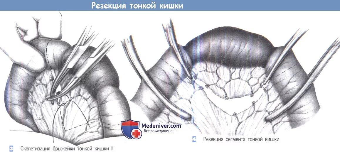 Этапы операции резекции тонкой кишки. Клиновидная резекция тонкой кишки. Инструменты при резекции тонкой кишки. Сегментарная резекция кишки. Как восстановить кишечник после операции