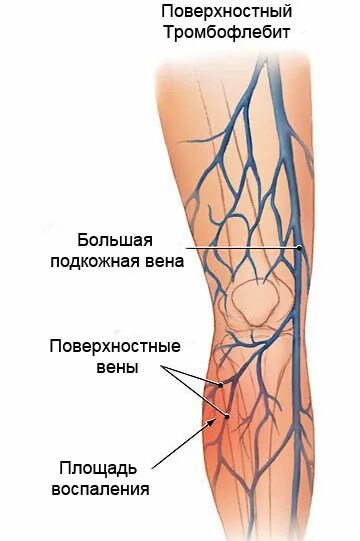 Острый тромбофлебит поверхностных,глубоких вен нижних конечностей. Острый тромбофлебит подкожных вен нижних конечностей. Восходящий тромбофлебит большой подкожной вены. Варикозное расширение подкожных вен нижних конечностей. Тромбоз подвздошной вены