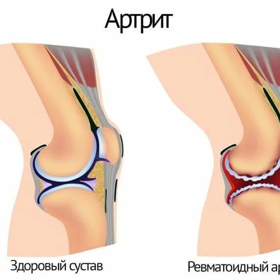 Артрит и артроз разница. Артрозо-артрит коленного сустава. Остеохондроз коленного сустава.