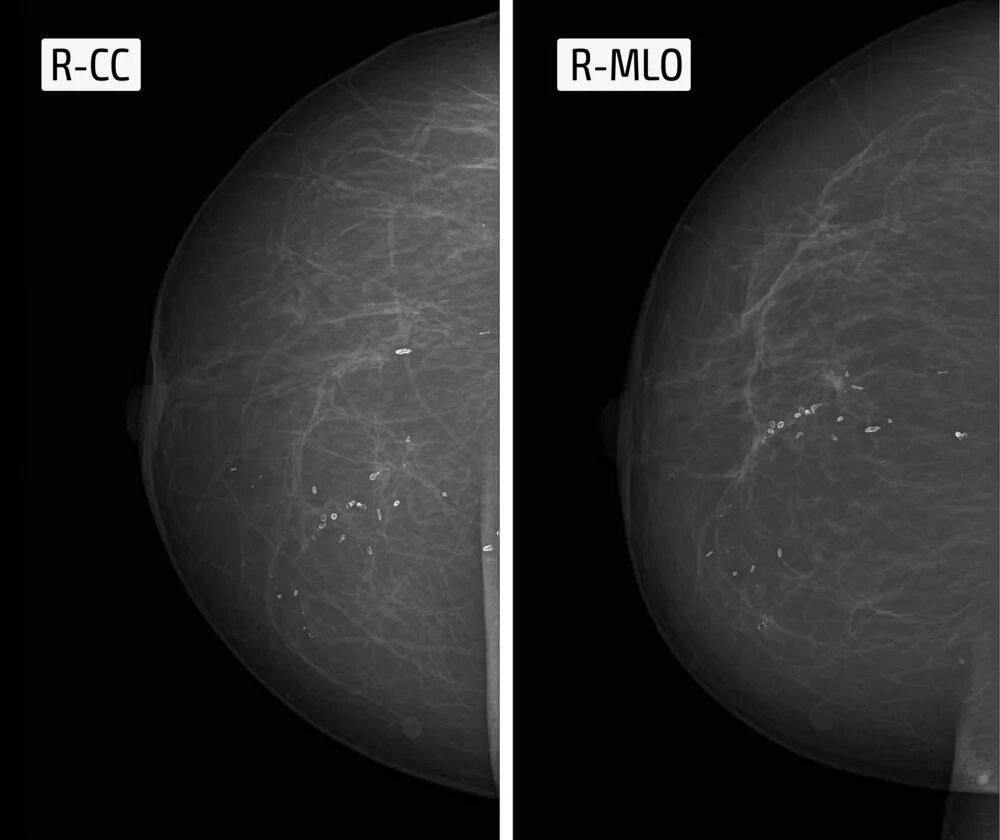 Округлые кальцинаты. Кальцинаты на маммографии. Протоковые кальцинаты маммография. Маммография микрокальцинаты. РМЖ кальцинаты маммограмма.