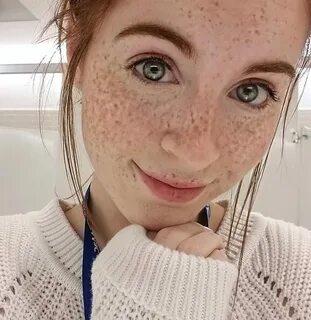 Freckles, freckles and ... freckles.