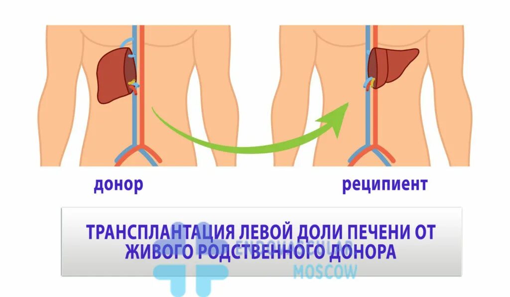 Реципиент трансплантация. Трансплантация печени. Трансплантология печени. Трансплантация печени и донор. Трансплантация части печени.