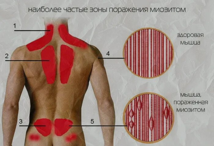 Простудил поясницу. Болит местами на спине. Продуло спину.