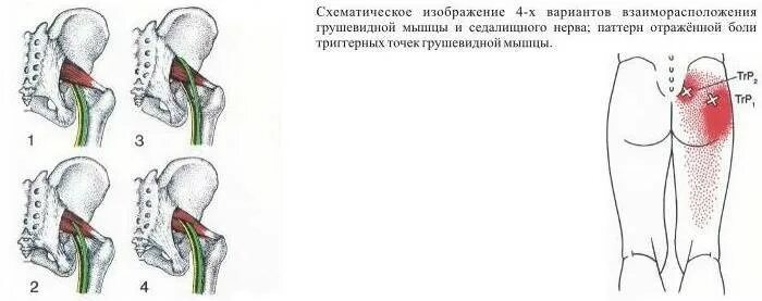 Грушевидной мышцы форум. Новокаиновая блокада грушевидной мышцы. грушевидная мышца иррадиация боли. симптом грушевидной мышцы симптомы. синдром грушевидной мышцы упражнения.