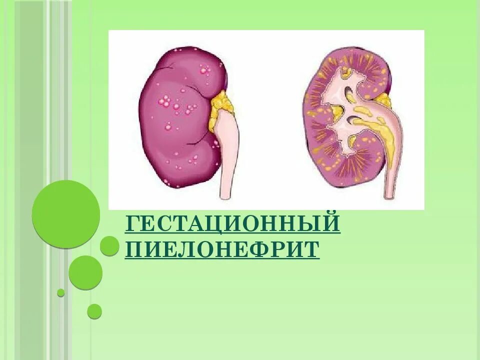Пиелонефрит у беременной женщины. Гестационный пиелонефрит. гестационный пиелонефрит показатели анализов.