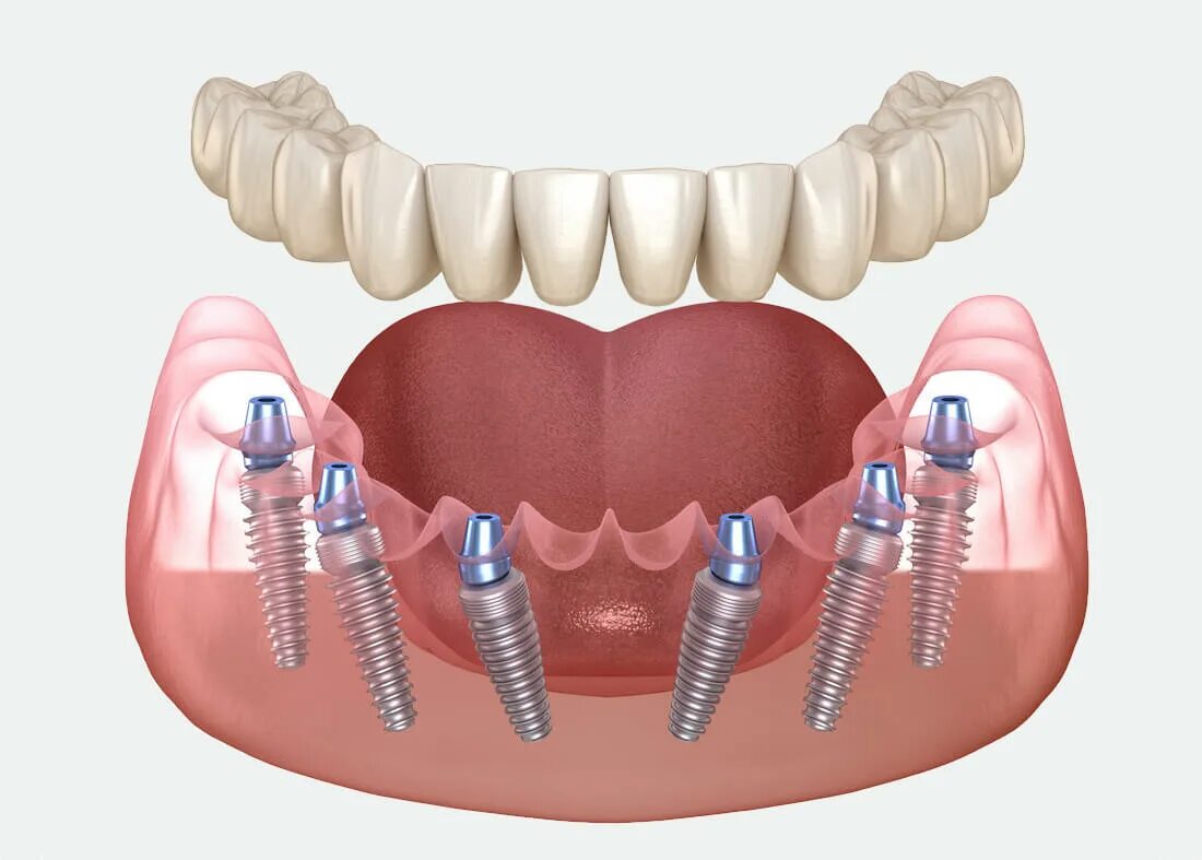 Протезирование с использованием имплантатов. Балочный протез на имплантах. Балочный протез на 4 имплантах. Протезирование с использованием имплантатов. Протезирование с использованием имплантатов.