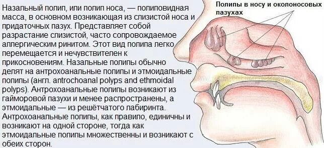 Риноаденоидит у ребенка что это