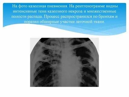 Пневмония в верхней левой доле