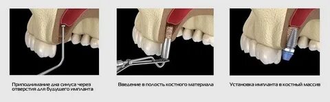 Закрытый синус