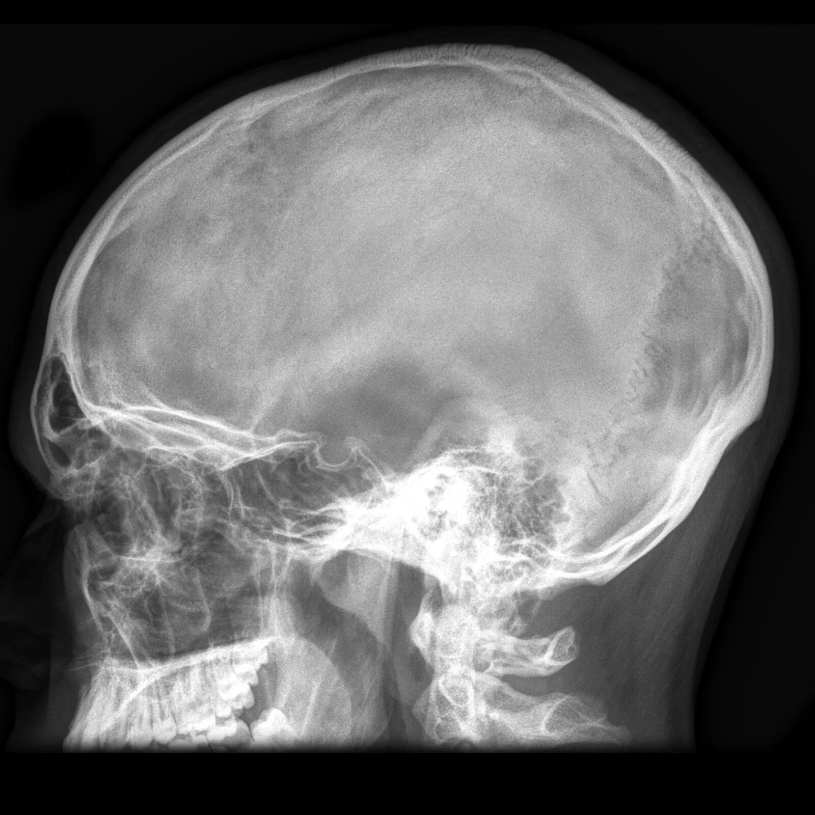 Сотрясение кости. Оскольчатый перелом черепа рентген. Диплоические вены черепа рентген. Менингиома рентген черепа. Перелом клиновидной кости черепа рентген.