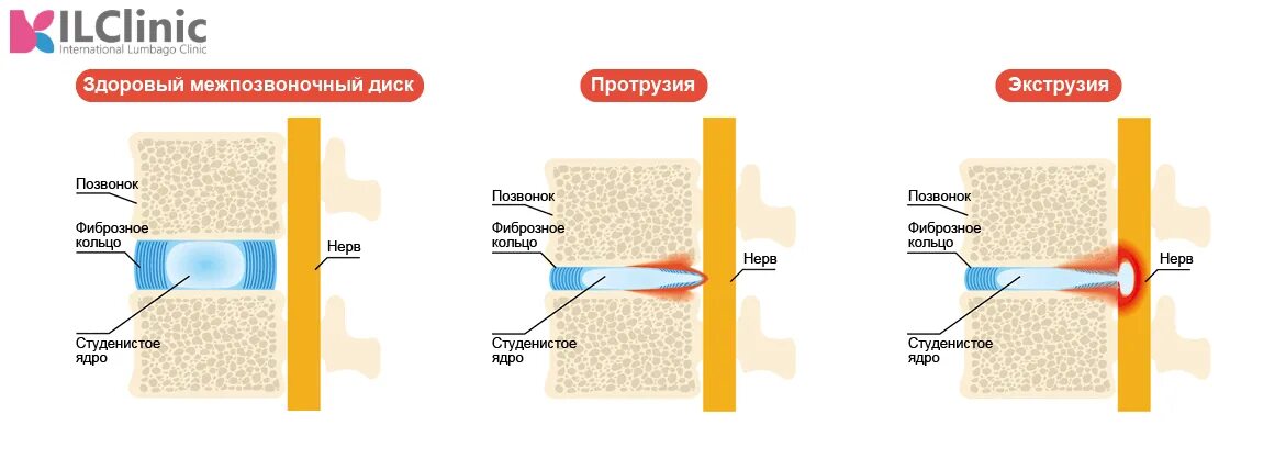 Протрузии экструзии межпозвонковых дисков. Протрузия экструзия секвестрация. Экструзия и протрузия дисков. Протрузии экструзии межпозвонковых дисков. Экструзия и грыжа дисков позвоночника что это такое.