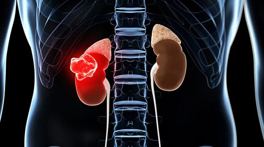 Есть ли рак почки. Пиелонефрит иллюстрация.
