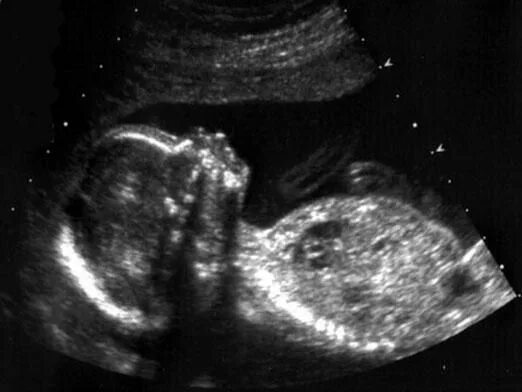BBC - Health: Unborn baby development gallery week by week