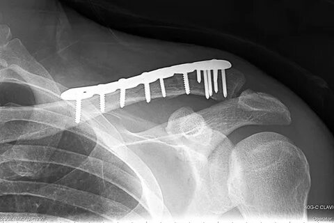 Fractured collarbone