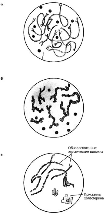 Включения мокроты. Микроскопия мокроты эластические волокна. эластические волокна в мокроте. коралловидные волокна в мокроте. мокрота нативный препарат микроскопия.