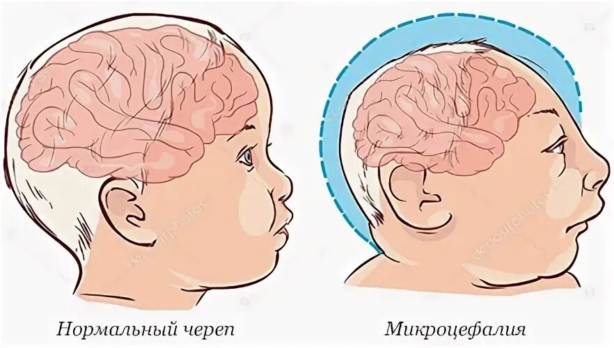 Симптомы микроцефалии у детей
