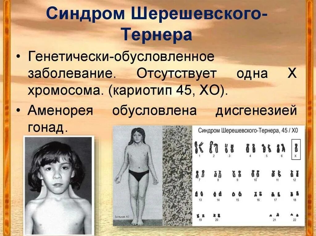 Синдром шеришевского тернера. Синдром шерешевского тернера кариотип. шерешевского тернера хромосомы. набор хромосом при синдроме тернера шерешевского. фенотипическая характеристика синдрома шерешевского тернера.