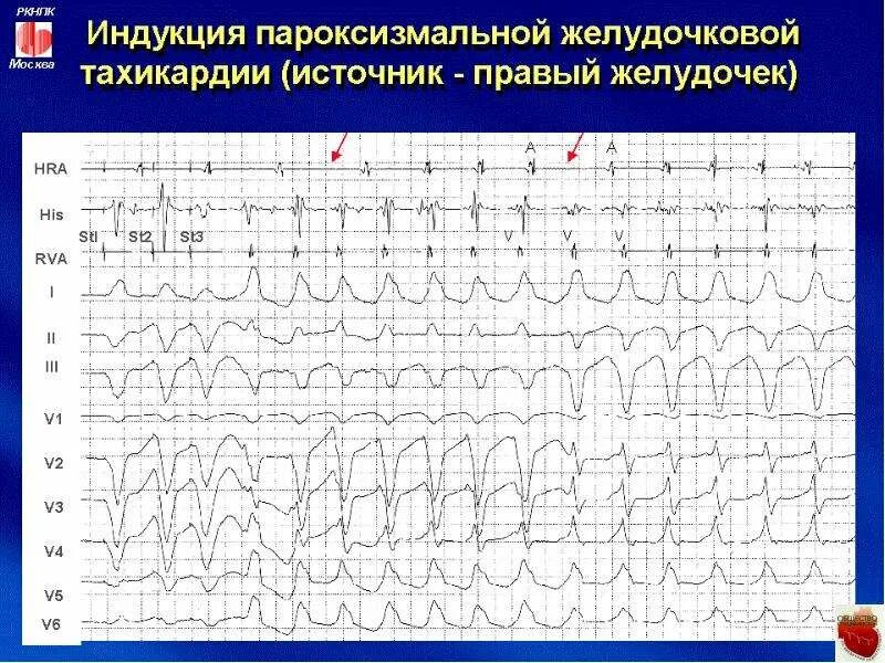 Фибрилляция предсердий карта вызова скорой. Пароксизмальная тахикардия карта вызова. суправентрикулярная тахикардия карта вызова. пароксизмальная наджелудочковая тахикардия карта вызова. наджелудочковая тахикардия карта вызова.